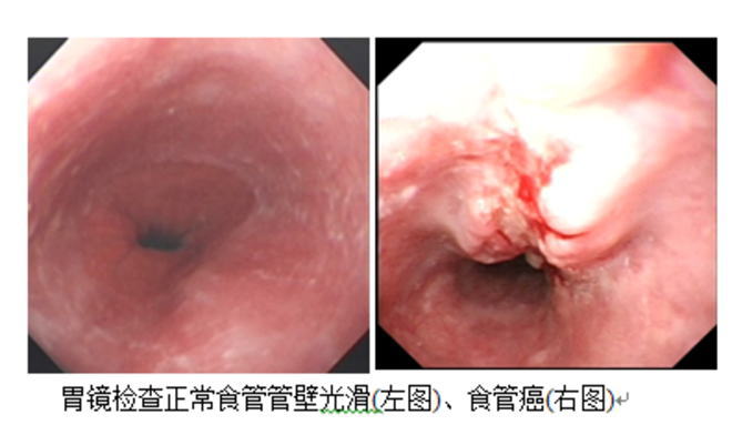 细胞免疫疗法在晚期食管癌治疗中的最新研究进展