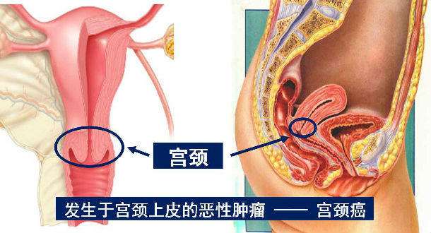 细胞免疫疗法联合放疗干预晚期宫颈癌最新临床研究