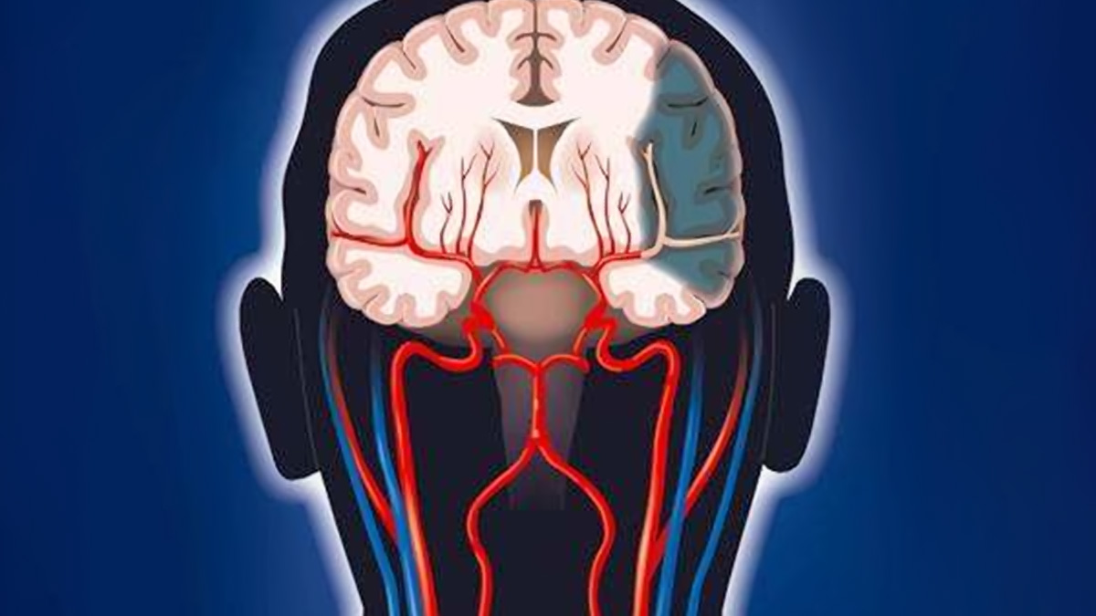 干细胞疗法改善脑卒中的临床案例：提高患者生活质量