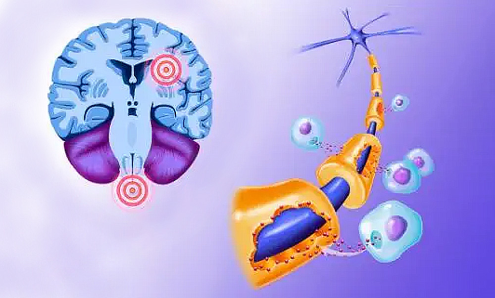 干细胞治疗多发性硬化症的应用研究