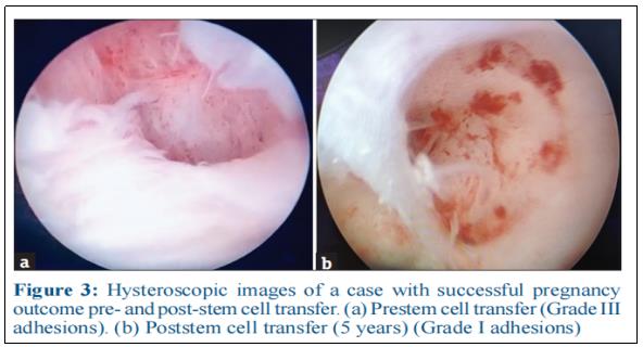 干细胞治疗宫腔粘连和宫内膜萎缩：5年随访研究