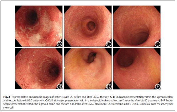 UC-MSCs移植2个月，73.2%溃疡性结肠炎患者达到临床缓解，43.9%患者经历粘膜愈合！