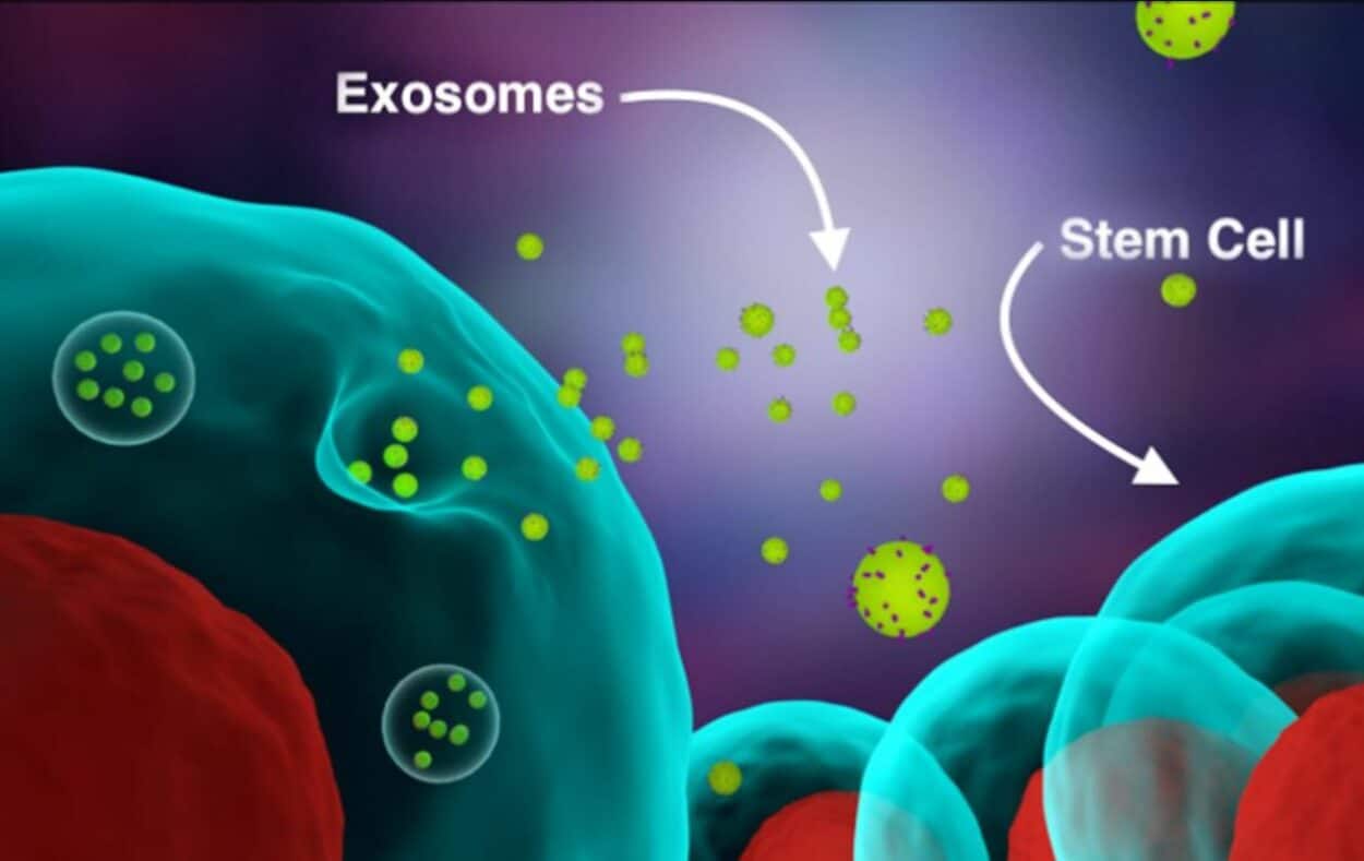 目标病变指数下降100%，病变厚度、红斑和硬结显著减少！银屑病患者接受高剂量外泌体治疗后病情显著改善！